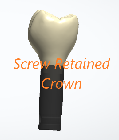 Screw Retained Crown